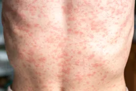 Low measles vaccine rates in parts of B.C. calls for open discussion: experts