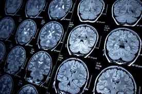N.B. mystery illness: Health minister says he ‘forgot’ he sent letter dismissing neurologist