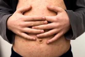 Check your measles vaccination, B.C. urges, as Ontario and Texas outbreaks grow