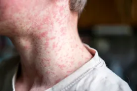 Saskatchewan Health Authority reports 6th measles case in province’s southwest