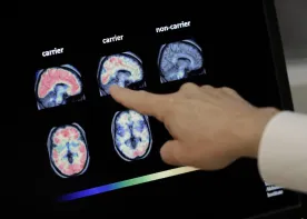 Shingles vaccine cuts dementia risk by 20%, study finds