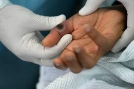 Uptick in B.C. Mpox cases spurs vaccination appeal to those at risk