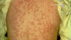 Measles advisory issued for Taber Health Centre