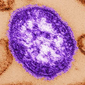 Alberta Medical Association warns measles will rise, says ramped-up health campaign needed