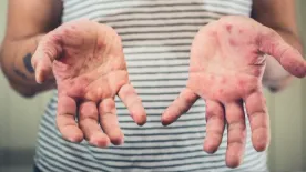 Manitoba measles cases climb as vaccination rates fall