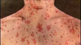 Alberta ramps up measles vaccination campaign as 3 hospitalized in intensive care