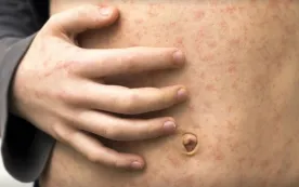 AHS warns of possible measles exposures in Taber, Whitecourt and Grimshaw
