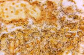 Montreal public health reports sharp increase in tuberculosis, syphilis cases